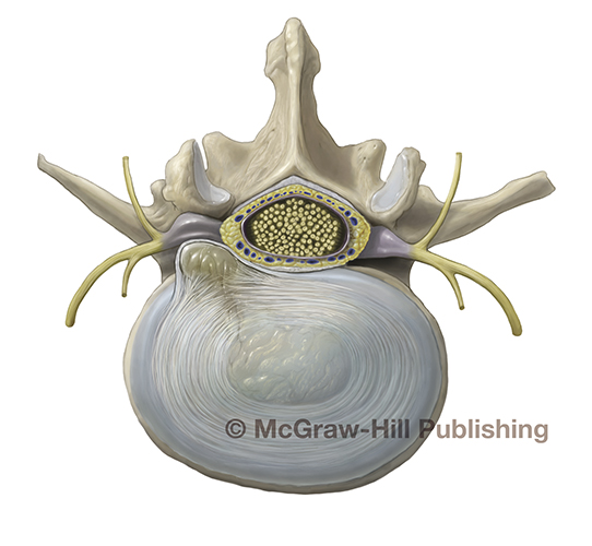 Orthopaedic medical illustration of lumbar disc herniation compressing a spinal nerve root