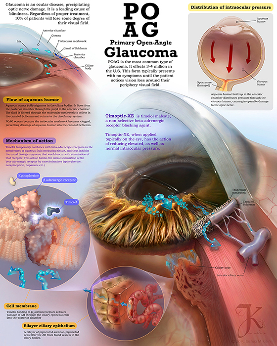 Ophthalmology editorial illustration of glaucoma and optic nerve damage